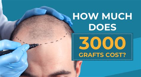 Understanding the Recovery Process of Blue Magic Hair Transplant